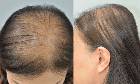 Alopecia: sintomas, causas, todos os remédios 3 alopecia 2
