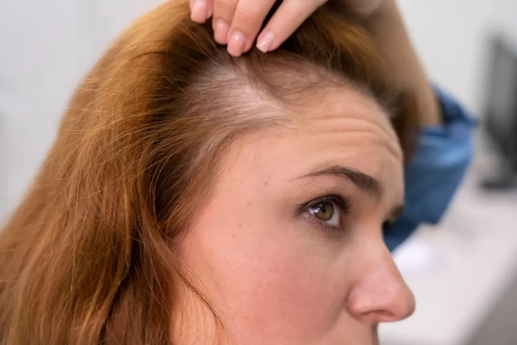 Alopecia: sintomas, causas, todos os remédios 4 alopecia androgenetica