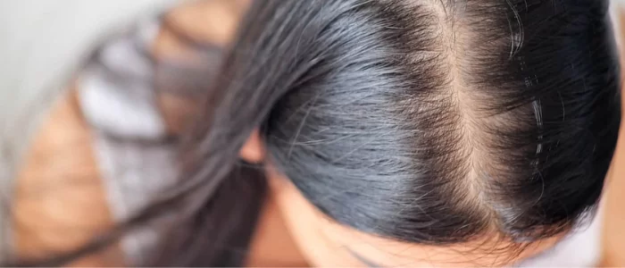 alopecia androgenetica femina