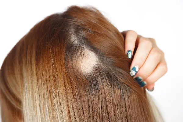 Alopecia: sintomas, causas, todos os remédios