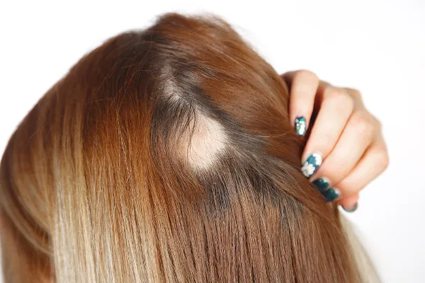 Alopecia: sintomas, causas, todos os remédios 1 Alopecia: sintomas, causas, todos os remédios