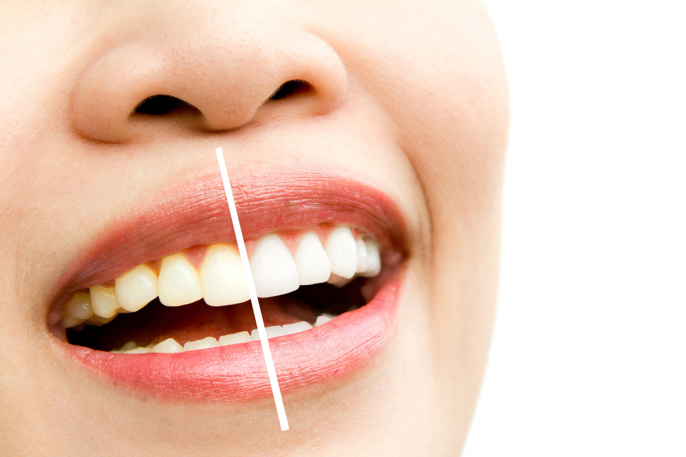 Qual o melhor tratamento para dentes podres? 3 Cafe mancha os dentes
